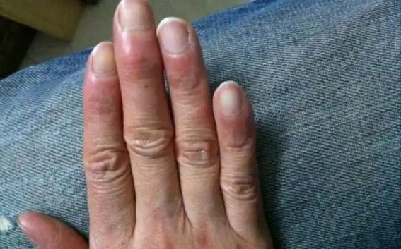 寒冬来临，尿酸高的人如何避免健康危机？