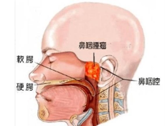 17年，32岁广州女子鼻咽癌手术顺利，3年后肝转移，主任：太无知