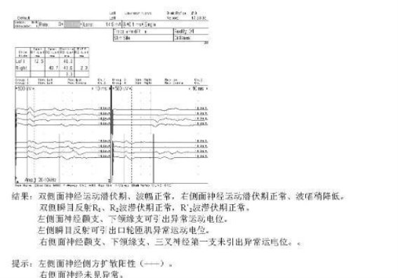 面肌痉挛十年折磨，广州袁阿姨终于战胜病魔