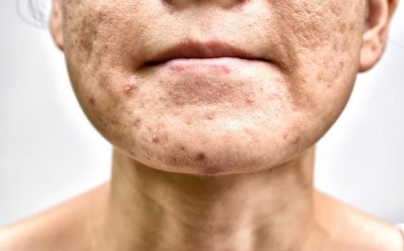 脱发愈发严重？除了遗传因素，别忽视这四个原因