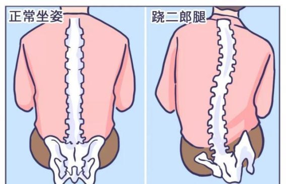 跷二郎腿的隐秘危害：不仅仅是对脊椎的伤害
