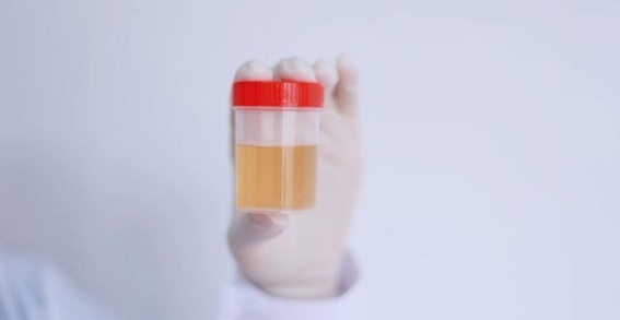 小便泡沫多并不一定是肾病，这4个因素可能是罪魁祸首