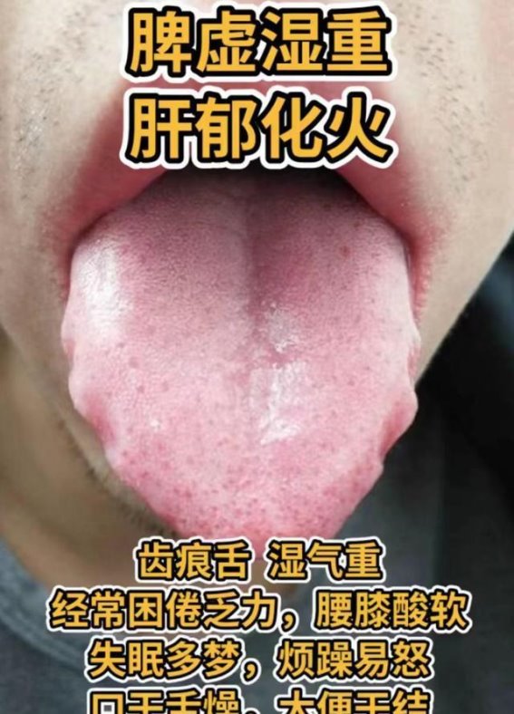 舌诊揭秘：从舌象看肾阴虚到气血不足的健康问题